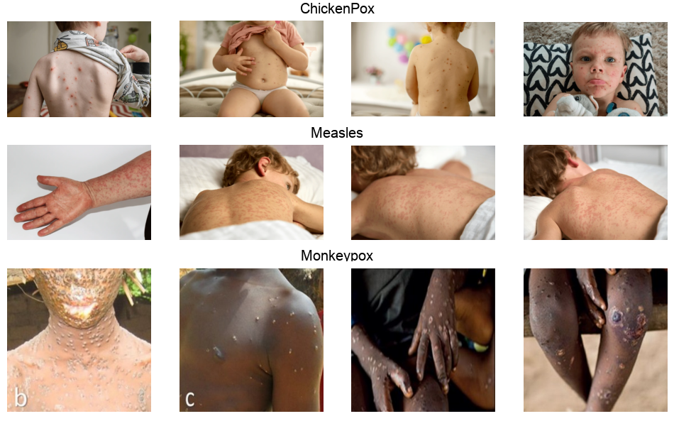 Viral Rash Classification